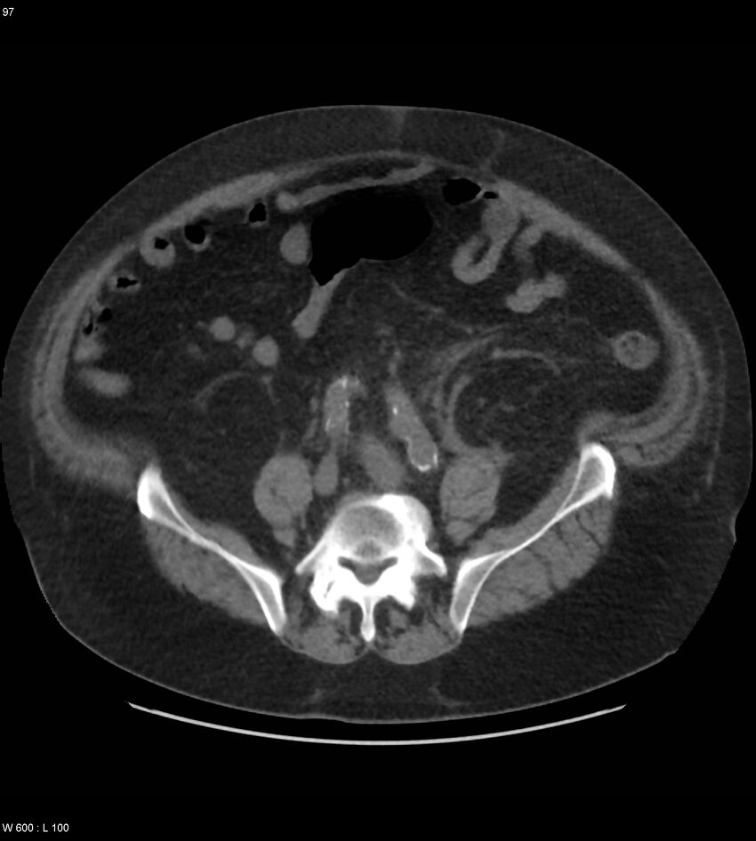 Abdominal aortic aneurysm with intramural hematoma then rupture (Radiopaedia 50278-55631 Axial non-contrast 93).jpg