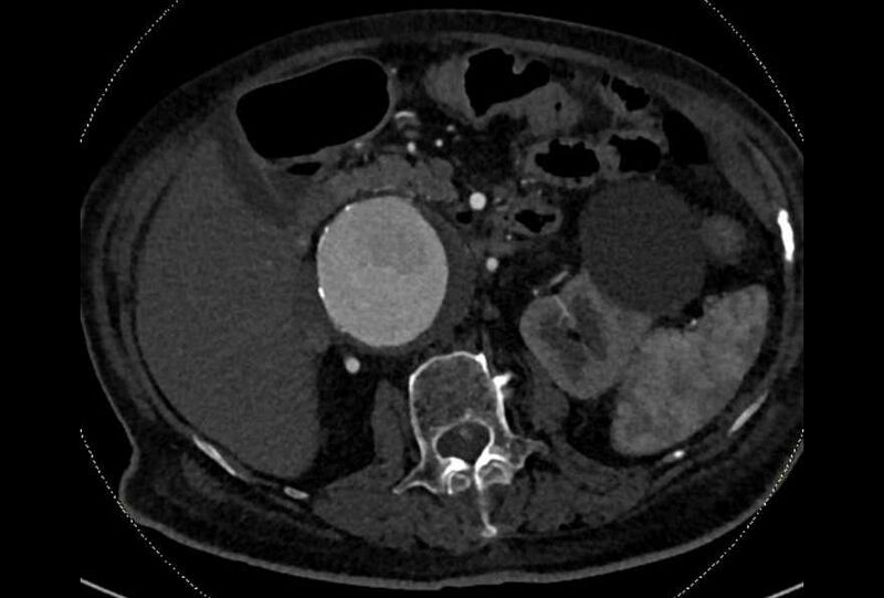 File:Abdominal aortic aneurysm with thrombus fissuration (Radiopaedia 73192-83919 Axial C+ arterial phase 57).jpg