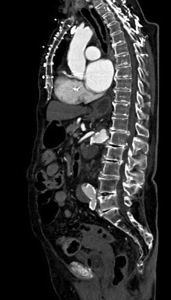 File:Abdominal aortic aneurysm with thrombus fissuration (Radiopaedia 73192-83919 Sagittal C+ arterial phase 67).jpg