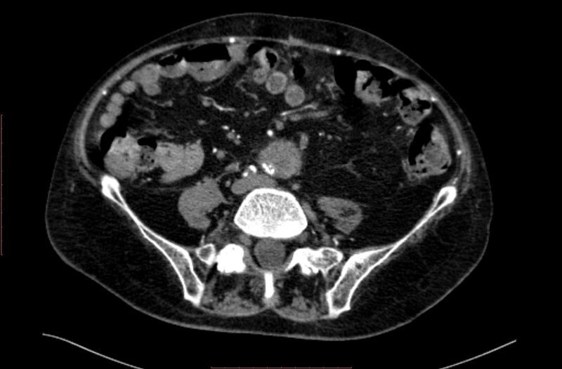 File:Abdominal aortic interposition tube graft and aneurysm thrombosis (Radiopaedia 71438-81857 Axial C+ arterial phase 131).jpg