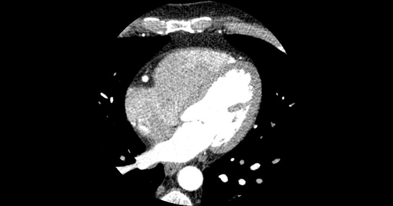 File:Aberrant left main coronary artery (ALMCA) arising from the right sinus with interarterial course (Radiopaedia 63251-71814 Axial C+ arterial phase 111).JPG