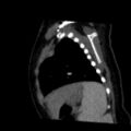 Aberrant left pulmonary artery (pulmonary sling) (Radiopaedia 42323-45435 Sagittal C+ arterial phase 46).jpg