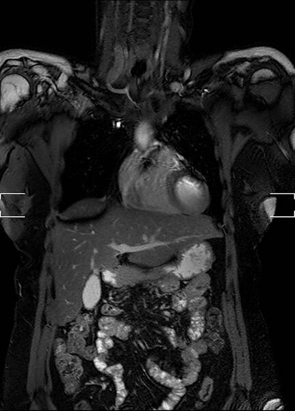 File:Aberrant right subclavian artery with background Takayasu arteritis (Radiopaedia 21423-21363 Coronal MRA 1).jpg