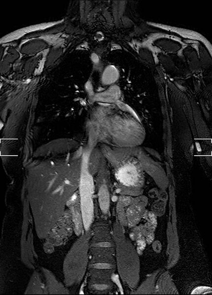 File:Aberrant right subclavian artery with background Takayasu arteritis (Radiopaedia 21423-21363 Coronal MRA 13).jpg