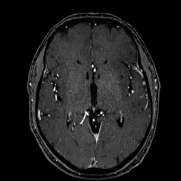 File:Accessory middle cerebral artery (Radiopaedia 73114-83828 Axial MRA 98).jpg
