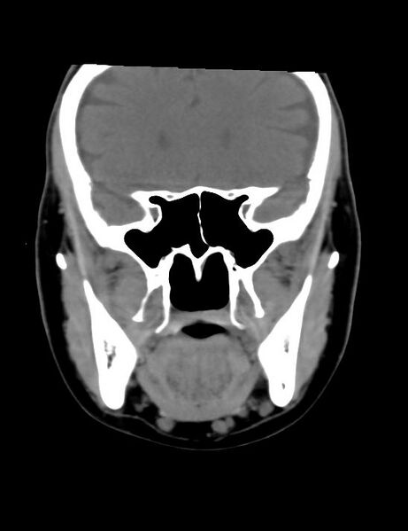 File:Accessory parotid glands (Radiopaedia 27289-27472 Coronal non-contrast 14).jpg