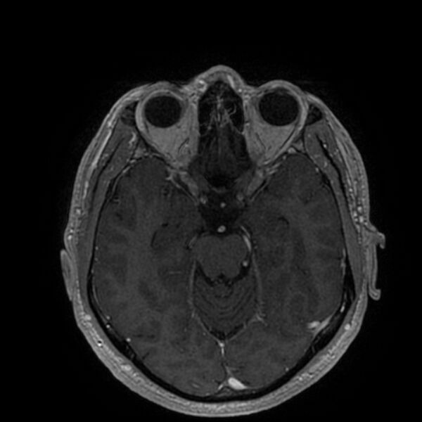 File:Acoustic schwannoma - intracanalicular (Radiopaedia 37247-39024 Axial T1 C+ 100).jpg