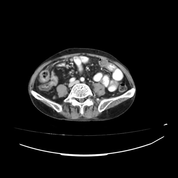File:Acute-on-chronic Crohn disease with enteroenteric fistula (Radiopaedia 66686-75987 B 25).jpg