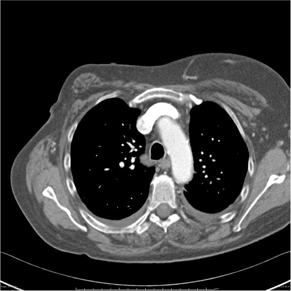 File:Acute-on-chronic pulmonary emboli (Radiopaedia 27925-28169 C+ CTPA 23).jpg