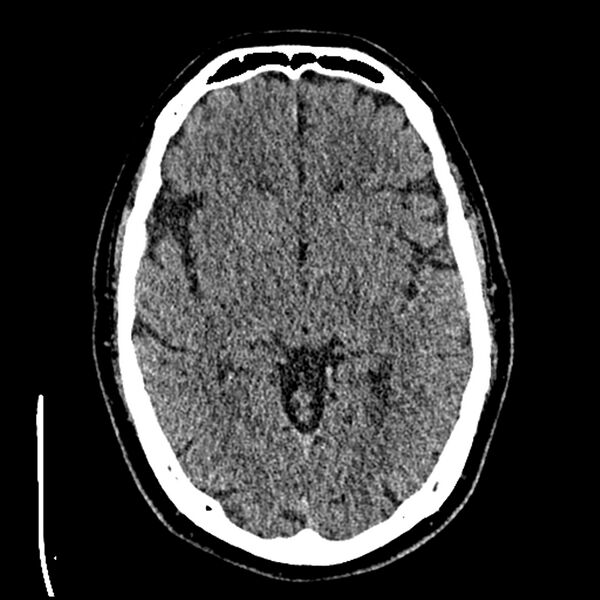 File:Acute A3 occlusion with ACA ischemic penumbra (CT perfusion) (Radiopaedia 72036-82525 Axial non-contrast thins 23).jpg