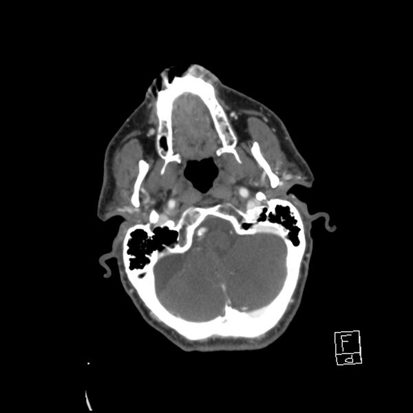 File:Acute ICA ischemic penumbra due to high-grade CCA stenosis (CT perfusion) (Radiopaedia 72038-82530 Axial C+ arterial phase 23).jpg