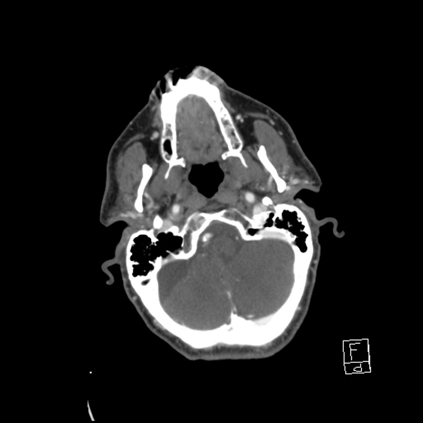Acute ICA ischemic penumbra due to high-grade CCA stenosis (CT perfusion) (Radiopaedia 72038-82530 Axial C+ arterial phase 23).jpg