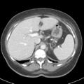Acute acalculous cholecystitis (Radiopaedia 48250-53123 Axial C+ portal venous phase 13).png