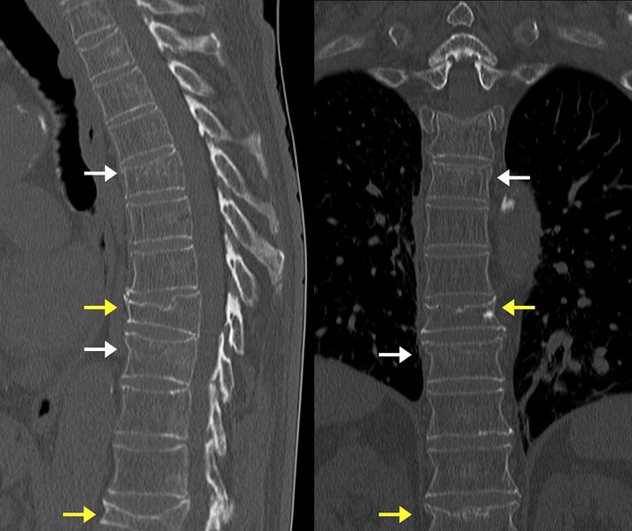 File:Acute and chronic vertebral compression fractures (Radiopaedia 31608-32496 A 1).jpg