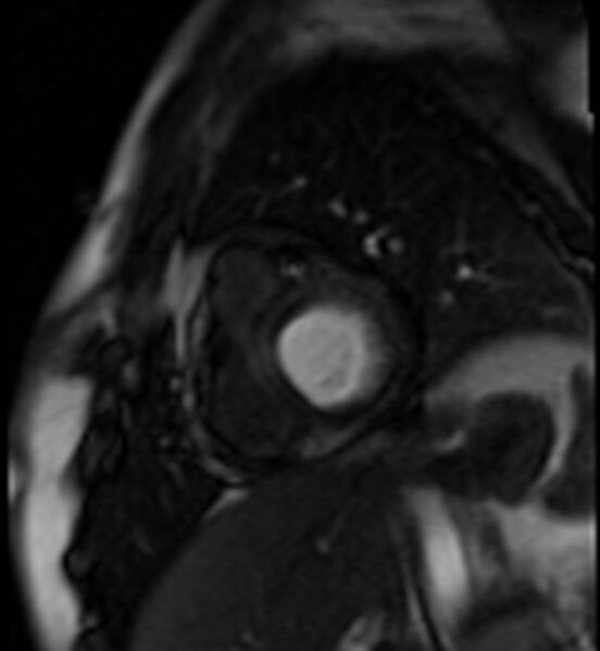 File:Acute anteroseptal myocardial infarction (Radiopaedia 68409-77945 Short axis (basal) Perfusion 11).jpg
