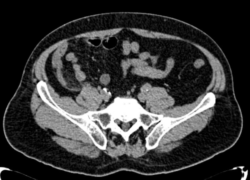 File:Acute appendicitis (Radiopaedia 13030-13091 Axial non-contrast 28).jpg
