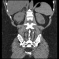Acute cholecystitis and ureteric colic (Radiopaedia 42330-45444 Coronal prone 77).jpg