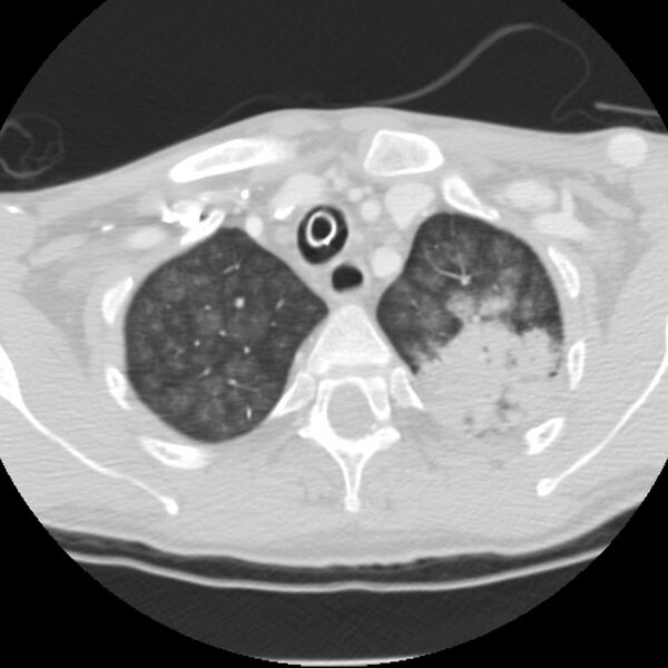File:Acute diffuse alveolar hemorrhage (Radiopaedia 41323-44158 Axial lung window 6).jpg