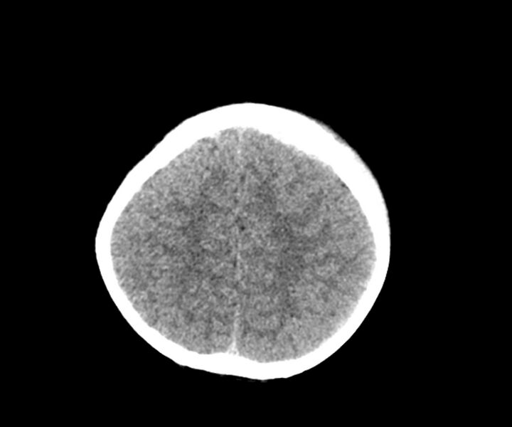 File:Acute epidural hematoma (Radiopaedia 63659-72335 Axial non-contrast 20).jpg