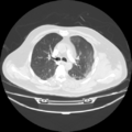 Acute heart failure (CT) (Radiopaedia 79835-93075 Axial lung window 17).png