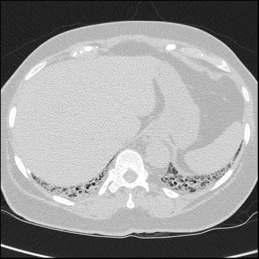 Acute interstitial pneumonitis (Radiopaedia 45404-49453 Axial lung window 70).jpg