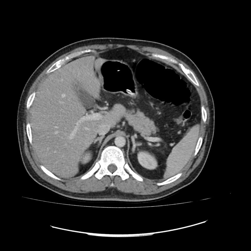 Acute mesenteric ischemia - superior mesenteric artery thrombosis (Radiopaedia 73947-84776 Axial C+ portal venous phase 12).jpg