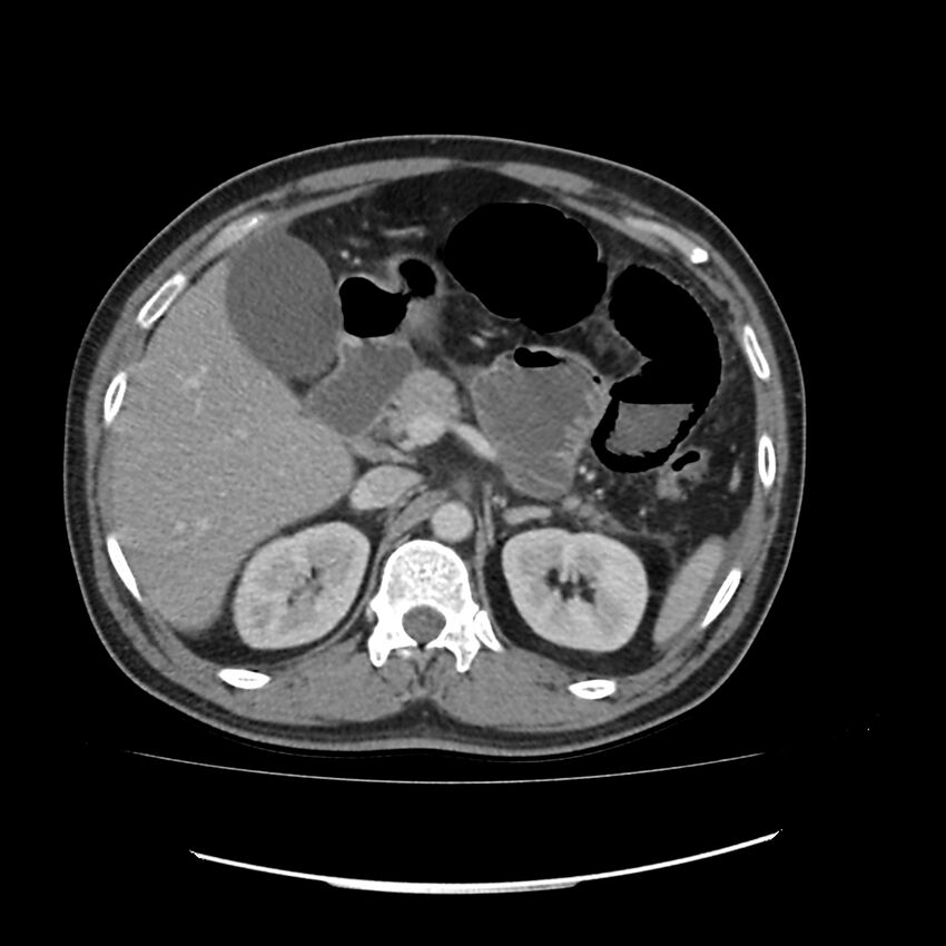 Acute mesenteric ischemia - superior mesenteric artery thrombosis (Radiopaedia 73947-84776 Axial C+ portal venous phase 26).jpg