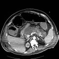 Acute pancreatic necrosis (Radiopaedia 13560-18502 Axial C+ portal venous phase 21).jpg