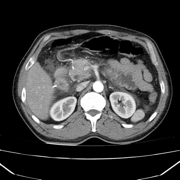 File:Acute pancreatitis (Radiopaedia 22572-22596 Axial C+ arterial phase 27).jpg