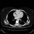 Acute pancreatitis - Balthazar C (Radiopaedia 26569-26714 Axial C+ portal venous phase 10).jpg