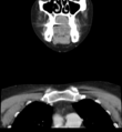 Acute parotitis (Radiopaedia 27425-27619 Coronal C+ portal venous phase 12).png