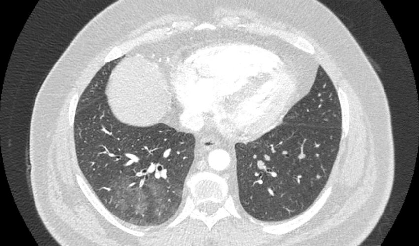 Acute pulmonary embolism with pulmonary infarcts (Radiopaedia 77688-89908 Axial lung window 90).jpg
