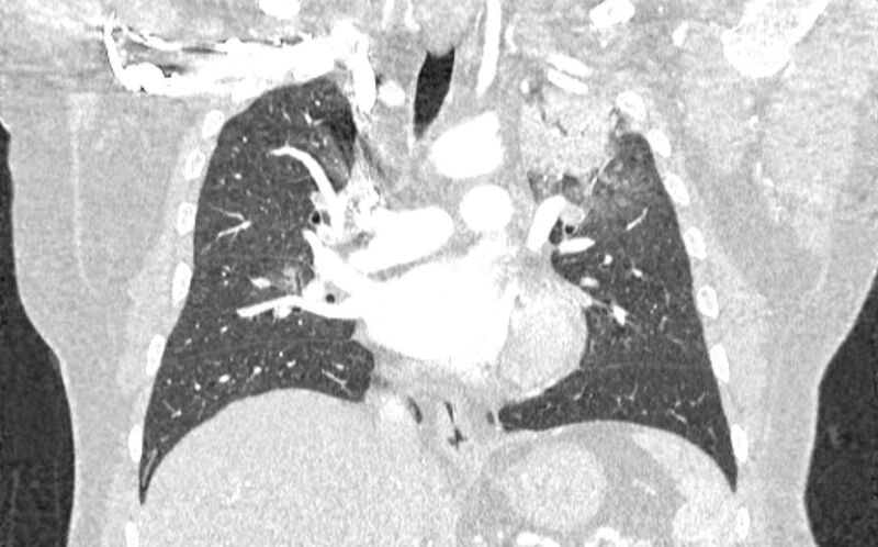 File:Acute pulmonary embolism with pulmonary infarcts (Radiopaedia 77688-89908 Coronal lung window 46).jpg