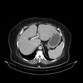 Acute pyelonephritis (Radiopaedia 25657-25837 Axial renal parenchymal phase 19).jpg