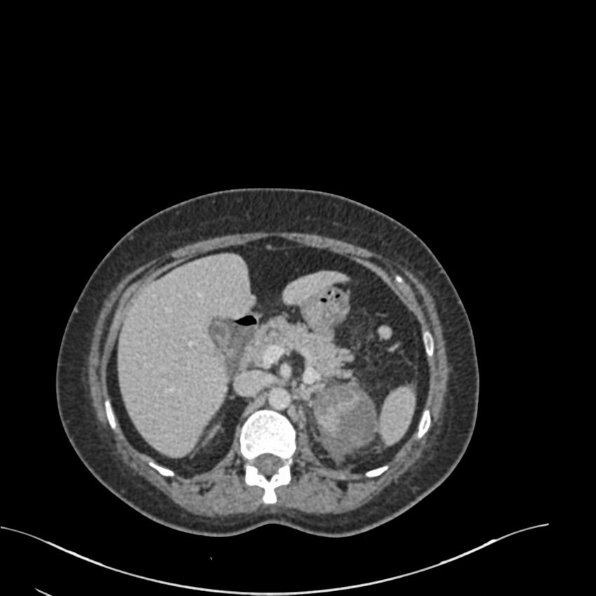 Acute pyelonephritis with renal vein thrombosis (Radiopaedia 58020-65053 Axial renal parenchymal phase 23).jpg