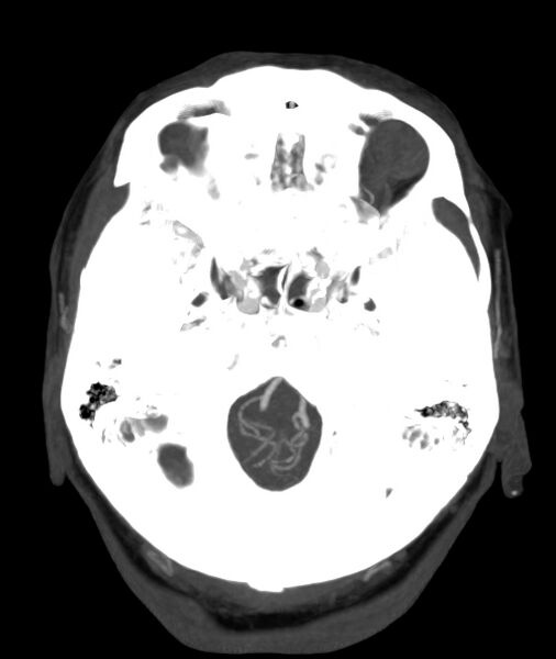 File:Acute right MCA M1 occlusion (Radiopaedia 62268-70454 Axial Phase 1 25).jpg