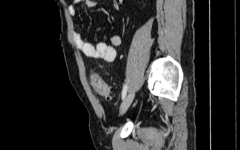 File:Acute sigmoid colon diverticulitis (Radiopaedia 55507-61976 Sagittal C+ portal venous phase 57).jpg