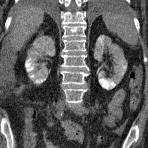 File:Acute tubular necrosis (Radiopaedia 28077-28334 Coronal non-contrast 15).jpg