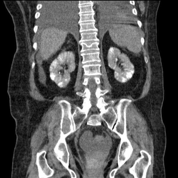 File:Acute tubular necrosis (Radiopaedia 28077-28334 D 60).jpg