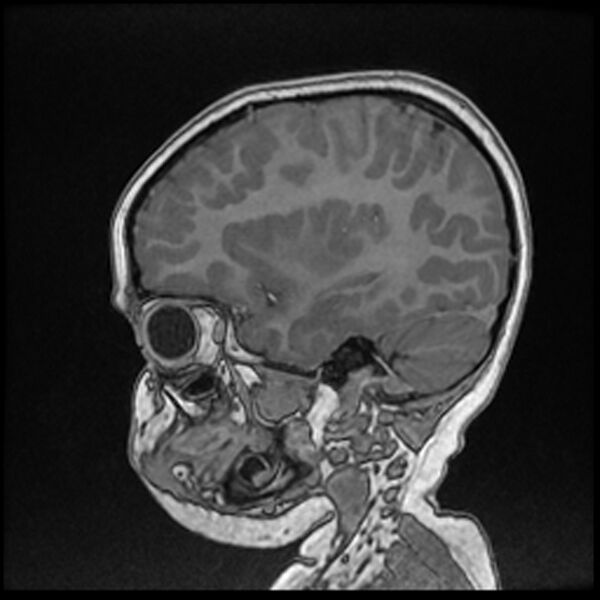 File:Adamantinomatous craniopharyngioma (Radiopaedia 77407-89529 Sagittal T1 C+ 38).jpg