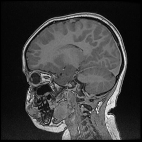 File:Adamantinomatous craniopharyngioma (Radiopaedia 77407-89529 Sagittal T1 C+ 82).jpg