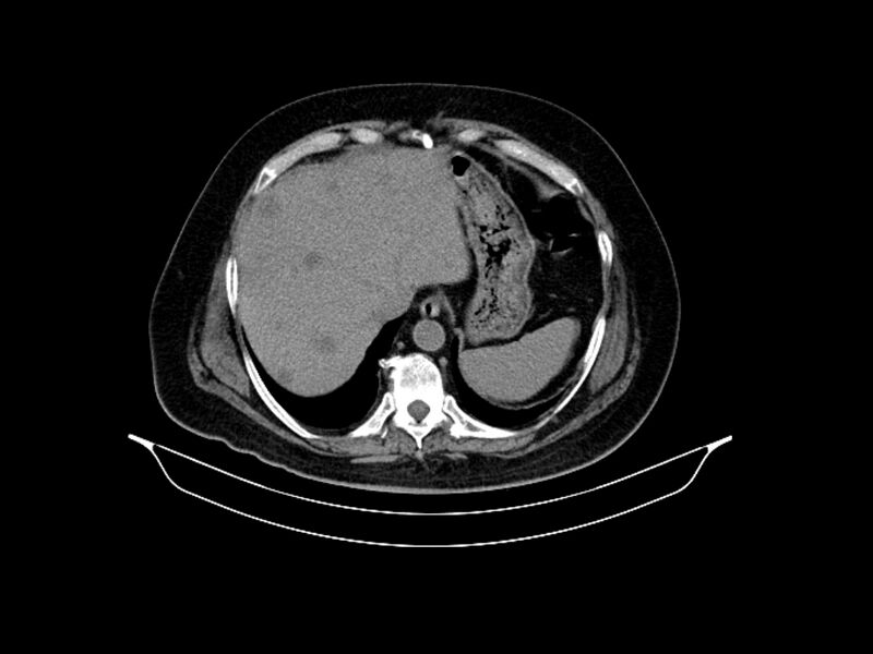File:Adenocarcinoma of pancreas with hepatic metastasis (Radiopaedia 64332-73122 Axial non-contrast 20).jpg
