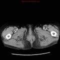 Adenocarcinoma of the colon (Radiopaedia 8191-9039 Axial liver window 83).jpg
