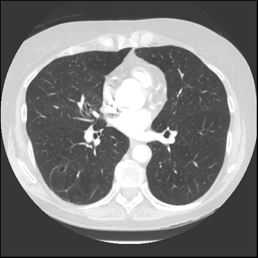 Adenocarcinoma of the lung (Radiopaedia 41015-43755 Axial lung window 68).jpg
