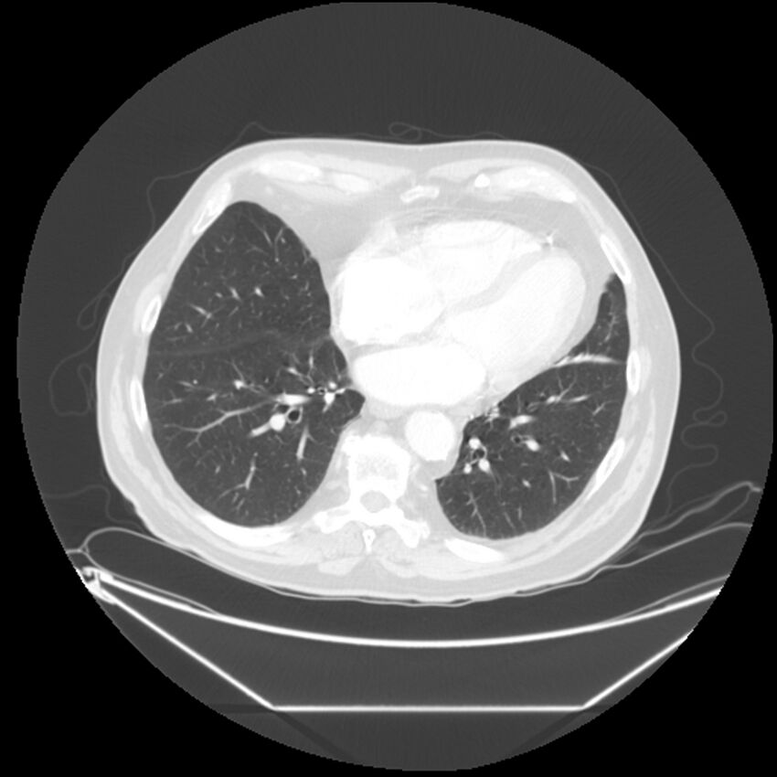 Adenocarcinoma of the lung (Radiopaedia 44876-48759 Axial lung window 54).jpg