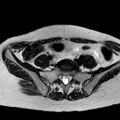 Adenomyoma of the uterus (huge) (Radiopaedia 9870-10438 Axial T2 36).jpg