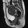 Adenomyosis - ovarian endometriomas (Radiopaedia 67031-76350 Sagittal T2 12).jpg