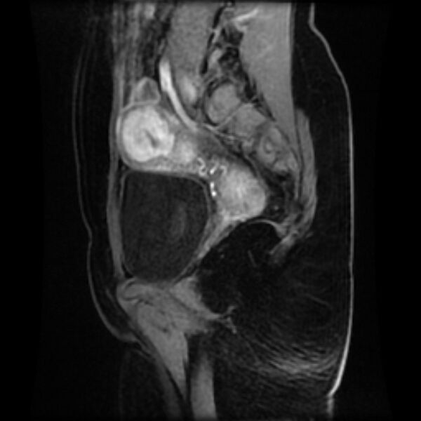 File:Adenomyosis within a septate uterus (Radiopaedia 69963-79981 Sagittal LAVA-Dyn 23).jpg