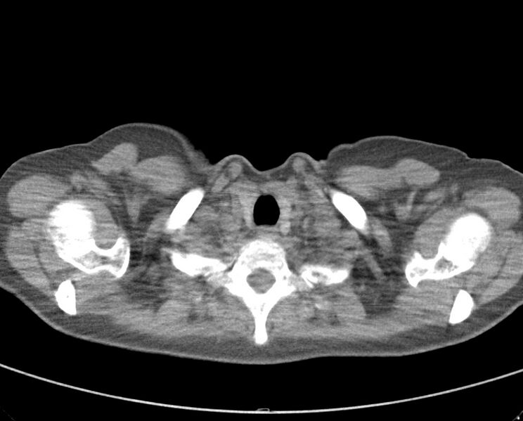 File:Adenosquamous lung carcinoma (Radiopaedia 22035-22030 non-contrast 11).jpg
