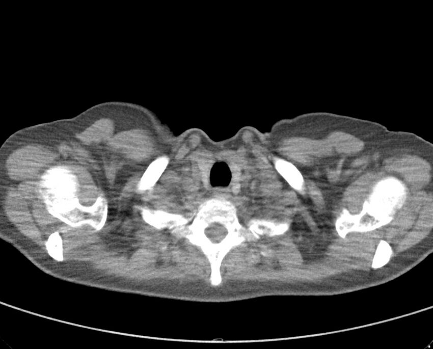 Adenosquamous lung carcinoma (Radiopaedia 22035-22030 non-contrast 11).jpg